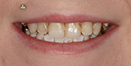 Before Image: Case 55 - front