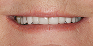 After Image: Case 59 - front