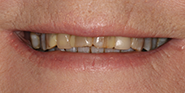 Before Image: Case 59 - front