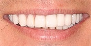 After Image: Case 62 - front