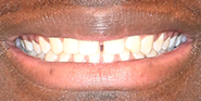 Before Image: Case 64 - front