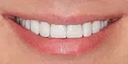 After Image: Case 65 - front