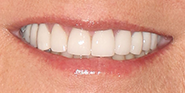 After Image: Case 66 - front