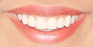 After Image: Case 67 - front