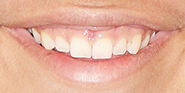 Before Image: Case 67 - front