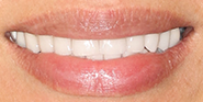 After Image: Case 68 - front