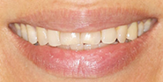 Before Image: Case 68 - front
