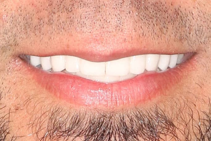 After Image: Case 70 - front