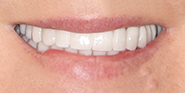 After Image: Case 71 - front