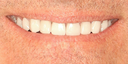 After Image: Case 72 - front