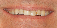 Before Image: Case 72 - front