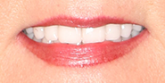 After Image: Case 73 - front