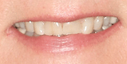 Before Image: Case 73 - front
