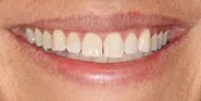 Before Image: Case 74 - front