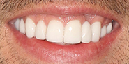 After Image: Case 75 - front