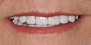 After Image: Case 76 - front