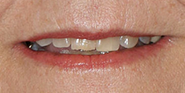 Before Image: Case 76 - front