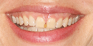 Before Image: Case 77 - front