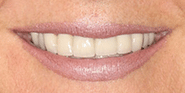 Before Image: Case 78 - front