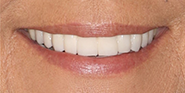 After Image: Case 79 - front