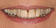 Before Image: Case 79 - front