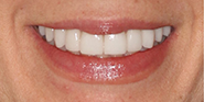 After Image: Case 80 - front