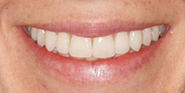 Before Image: Case 80 - front