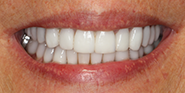 After Image: Case 81 - front