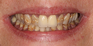 Before Image: Case 81 - front