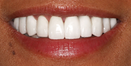 After Image: Case 82 - front