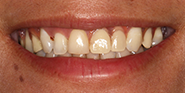 Before Image: Case 82 - front
