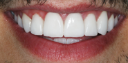 After Image: Case 83 - front