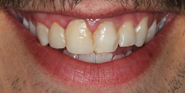 Before Image: Case 83 - front