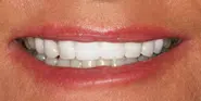 After Image: Case 84 - front