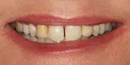 Before Image: Case 84 - front