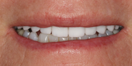 After Image: Case 85 - front