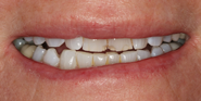 Before Image: Case 85 - front