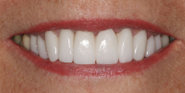 After Image: Case 86 - front