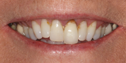 Before Image: Case 86 - front
