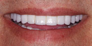 After Image: Case 87 - front