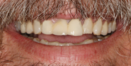 Before Image: Case 87 - front