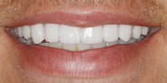 After Image: Case 88 - front