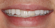Before Image: Case 88 - front