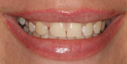 Before Image: Case 89 - front