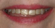 Before Image: Case 9 - front