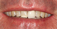 Before Image: Case 90 - front