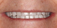 After Image: Case 91 - front