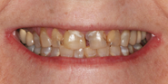 Before Image: Case 91 - front