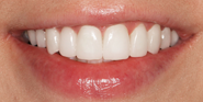 After Image: Case 92 - front