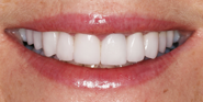 After Image: Case 93 - front